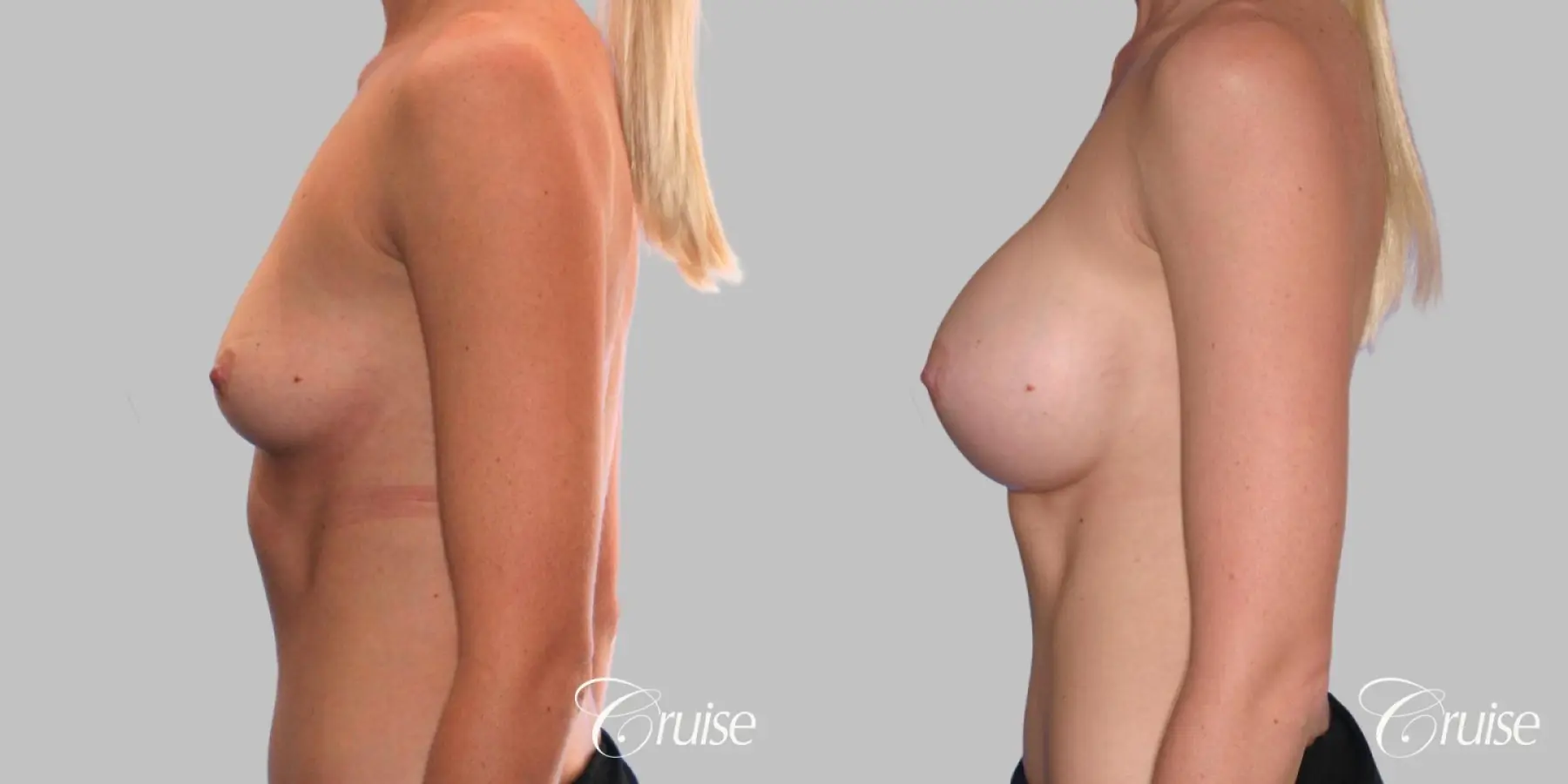 Breast Augmentation - Silicone HP 425cc - Before and After 3