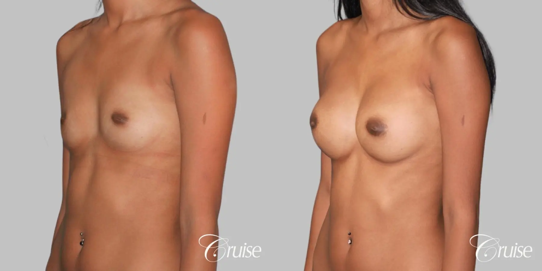 Breast Augmentation - Silicone MP 371cc - Before and After 2
