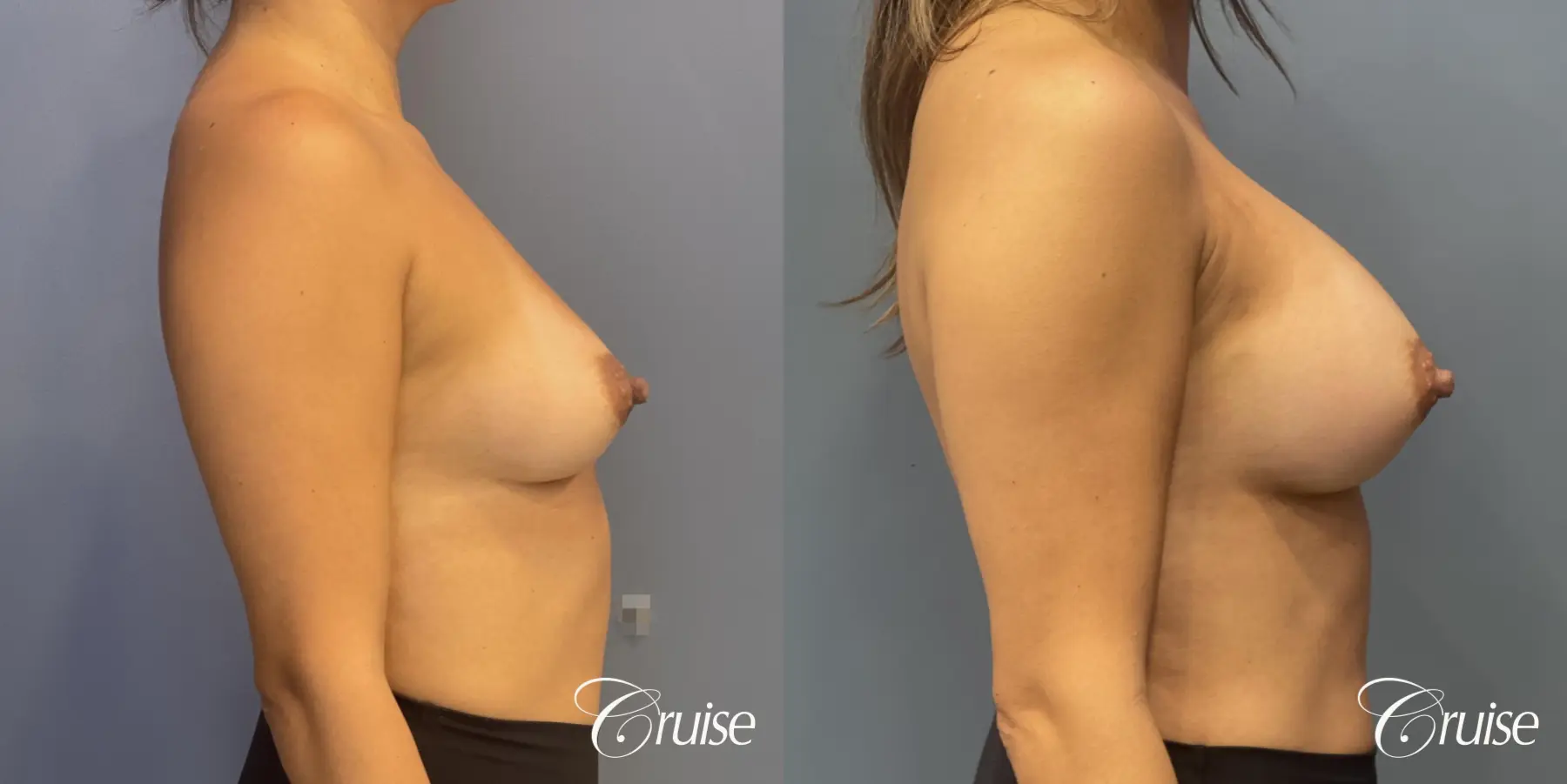 Breast Augmentation: Patient 70 - Before and After 4
