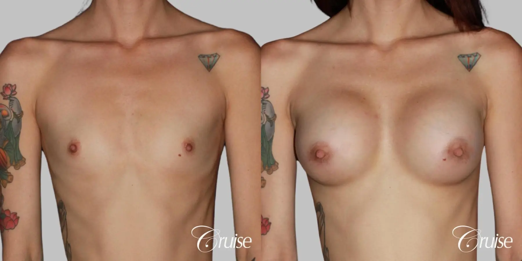 Breast Augmentation on Petite Patient - HP 375cc (silicone) - Before and After 1