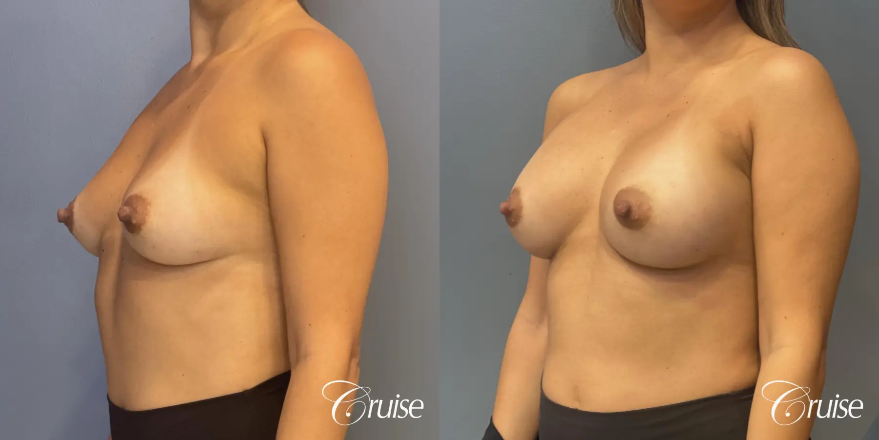 Breast Augmentation: Patient 70 - Before and After 3