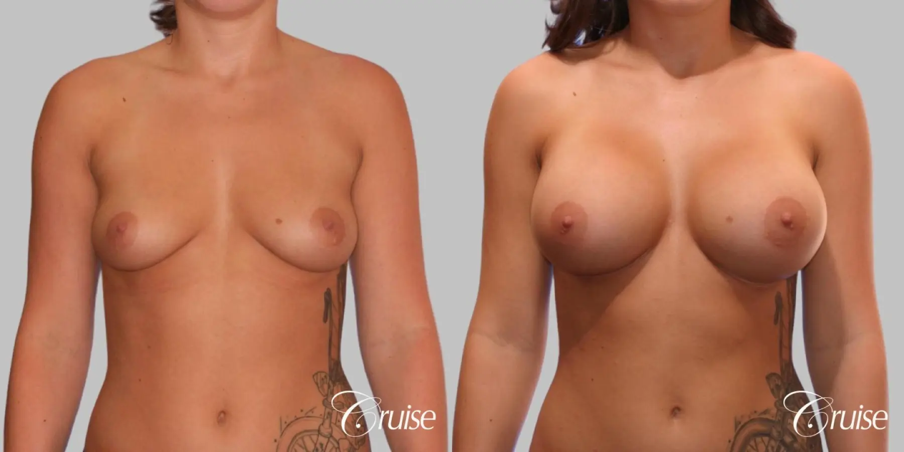 Breast Augmentation - Silicone HP 475cc - Before and After 1