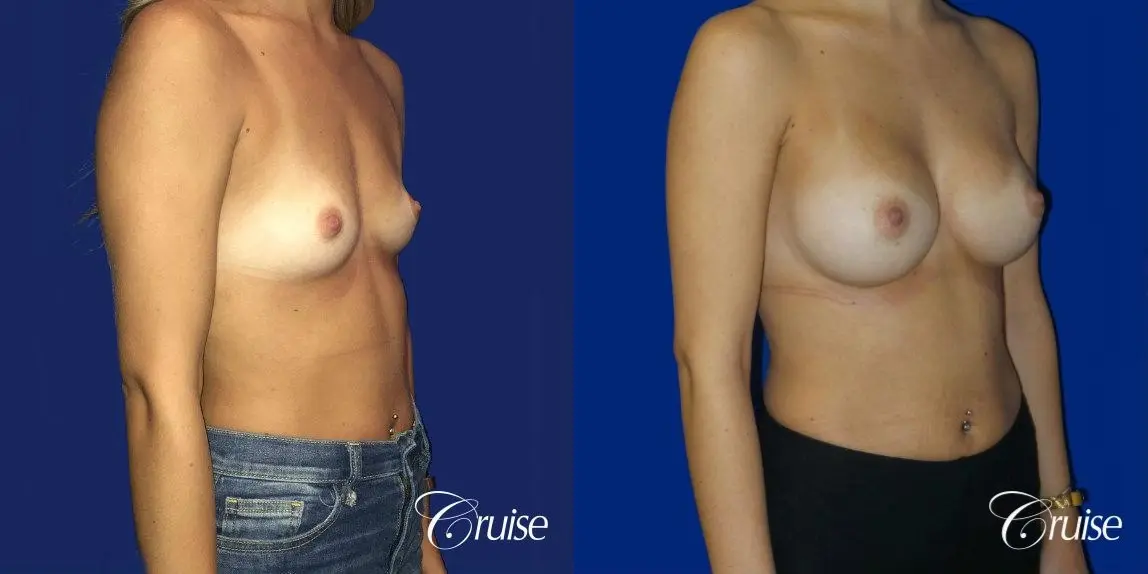 Breast Augmentation - Before and After 5