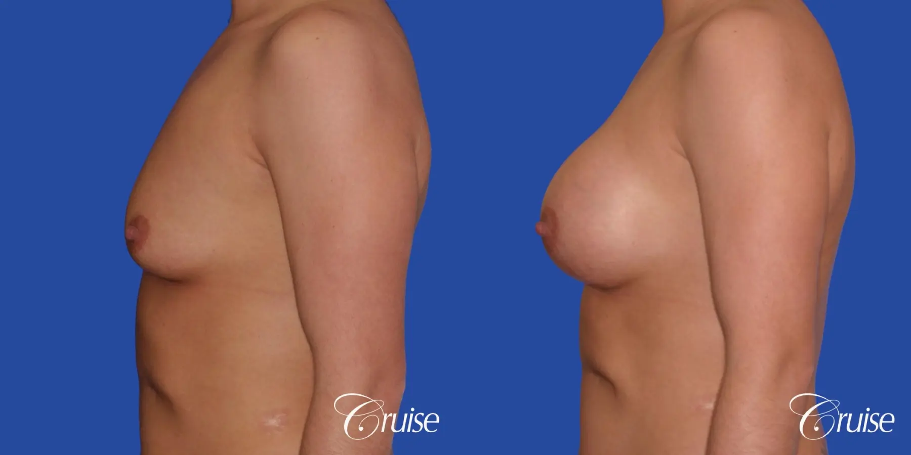 Breast Augmentation - Before and After 2