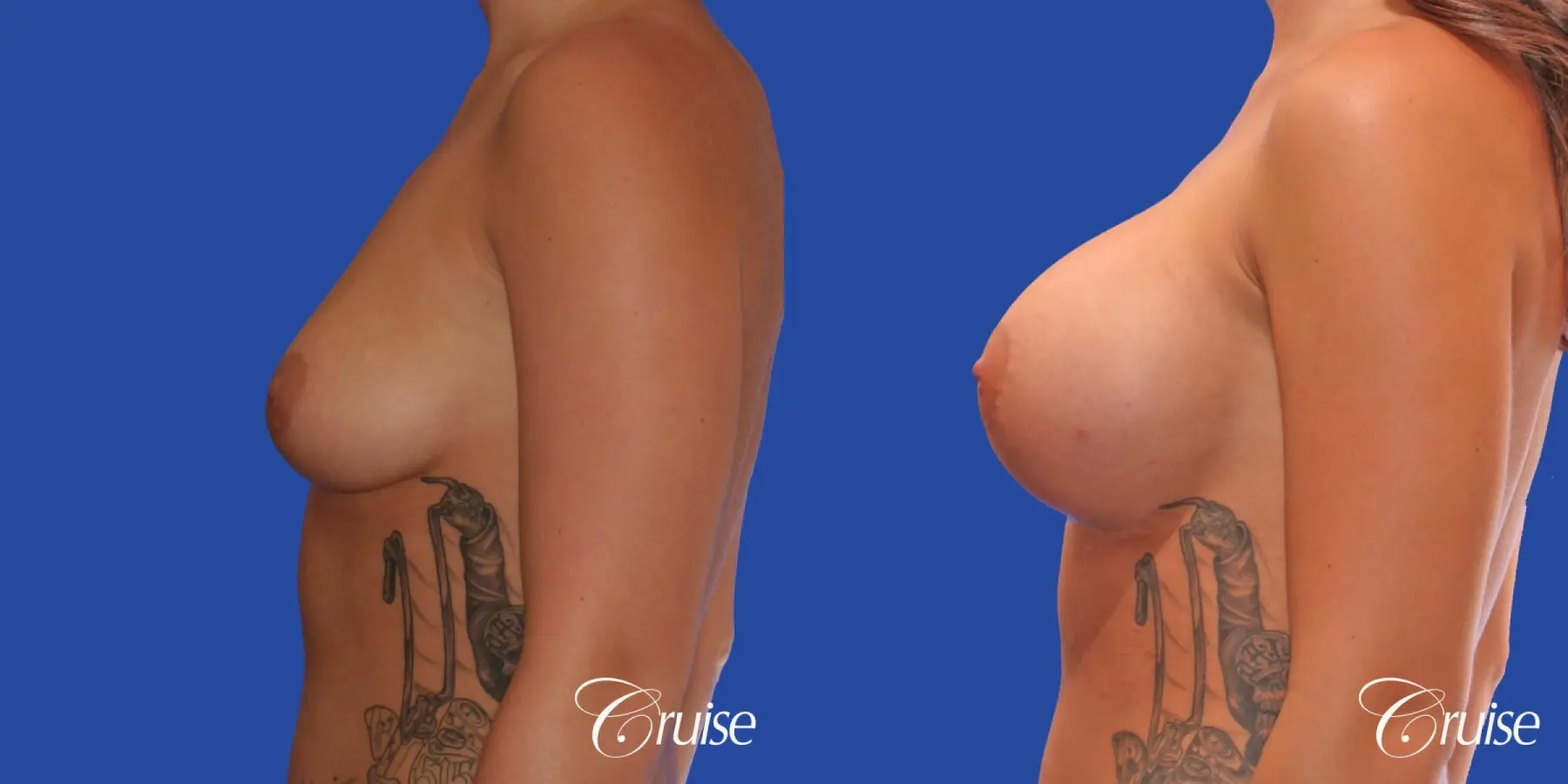 Breast Augmentation - Before and After 2