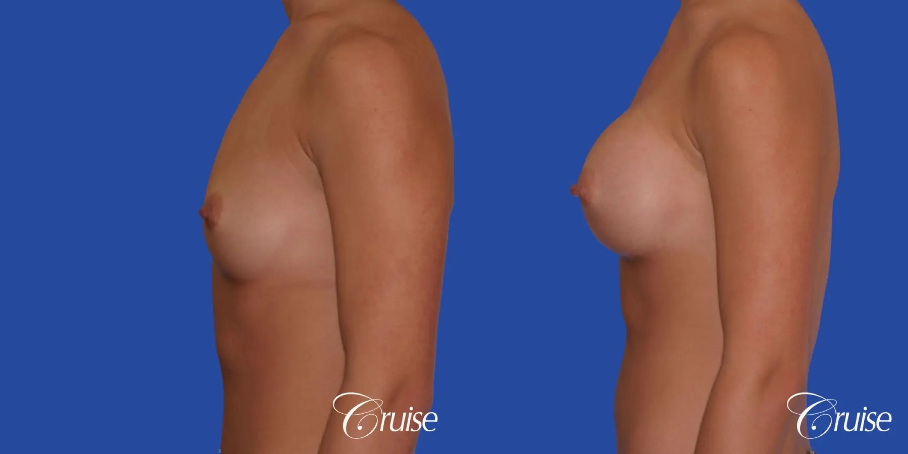 Breast Augmentation - Before and After 2