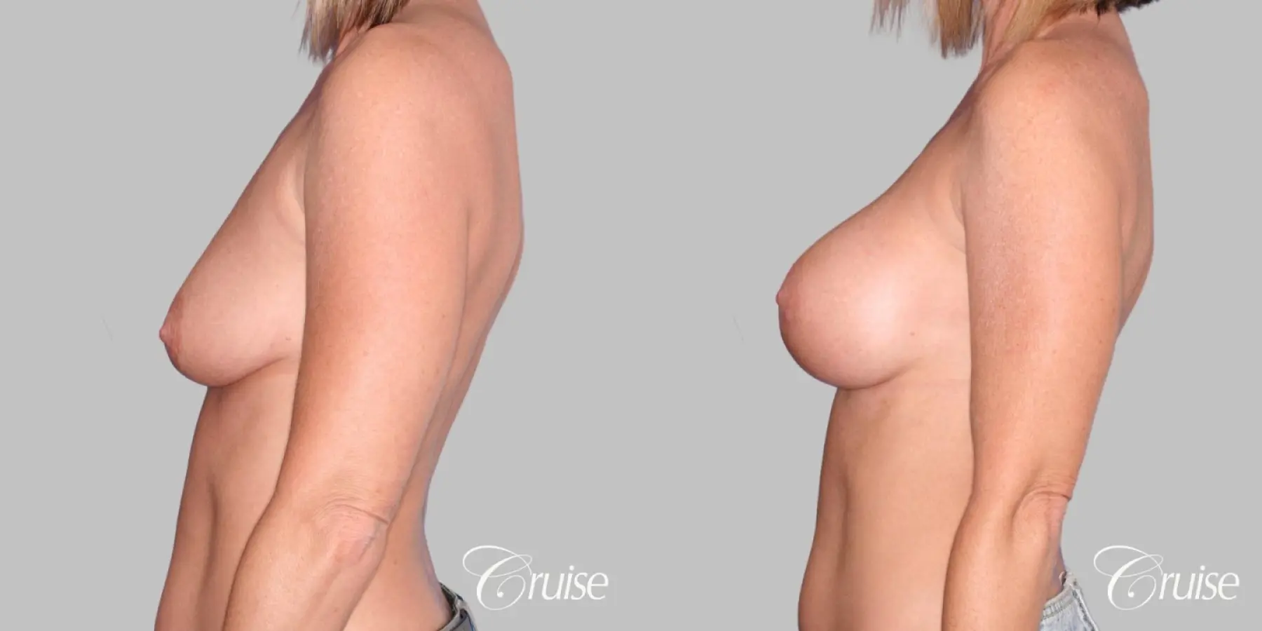 Breast Augmentation - Before and After 2