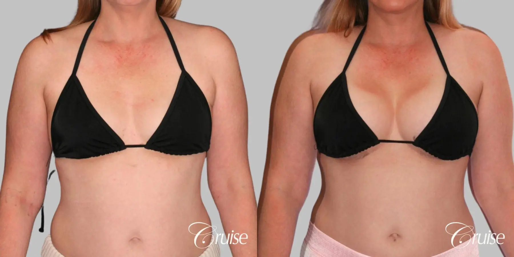 Breast Augmentation - Silicone HP 475cc - Before and After 3