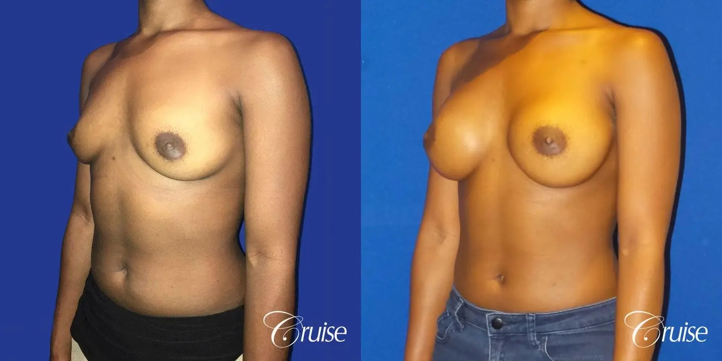 Breast Augmentation surgery Dr. Cruise - Before and After 2