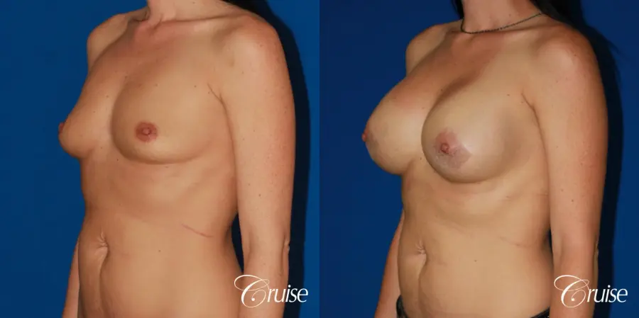 Breast Augmentation - Before and After 3