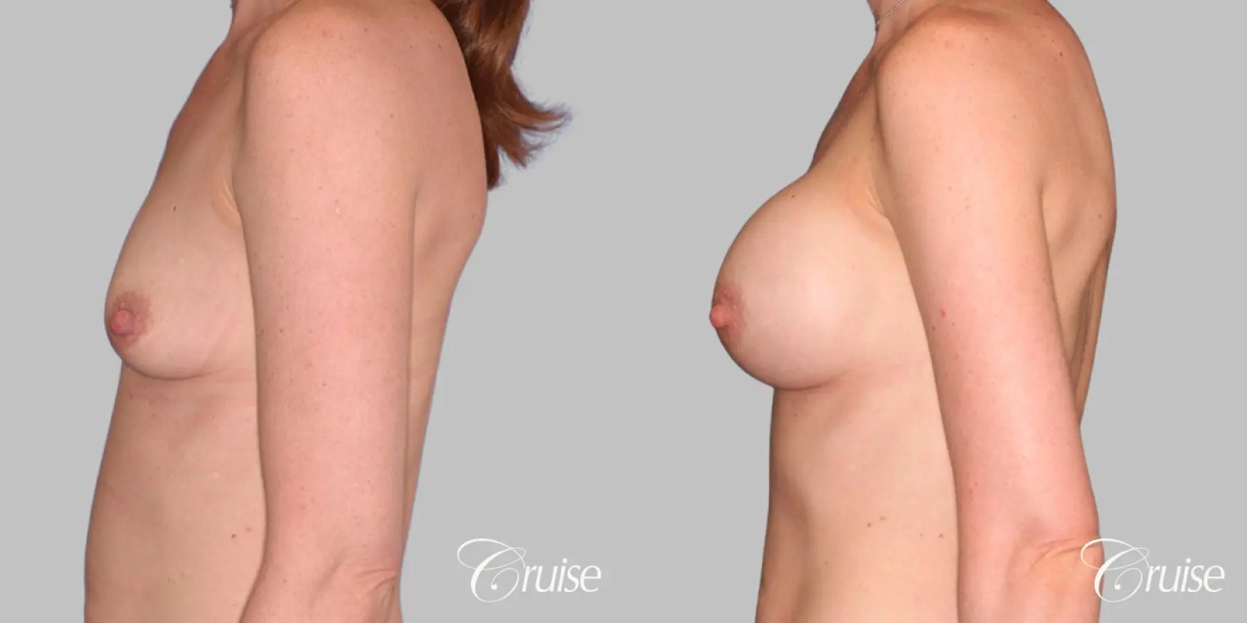 Breast Augmentation - Silicone HP 375cc - Before and After 2