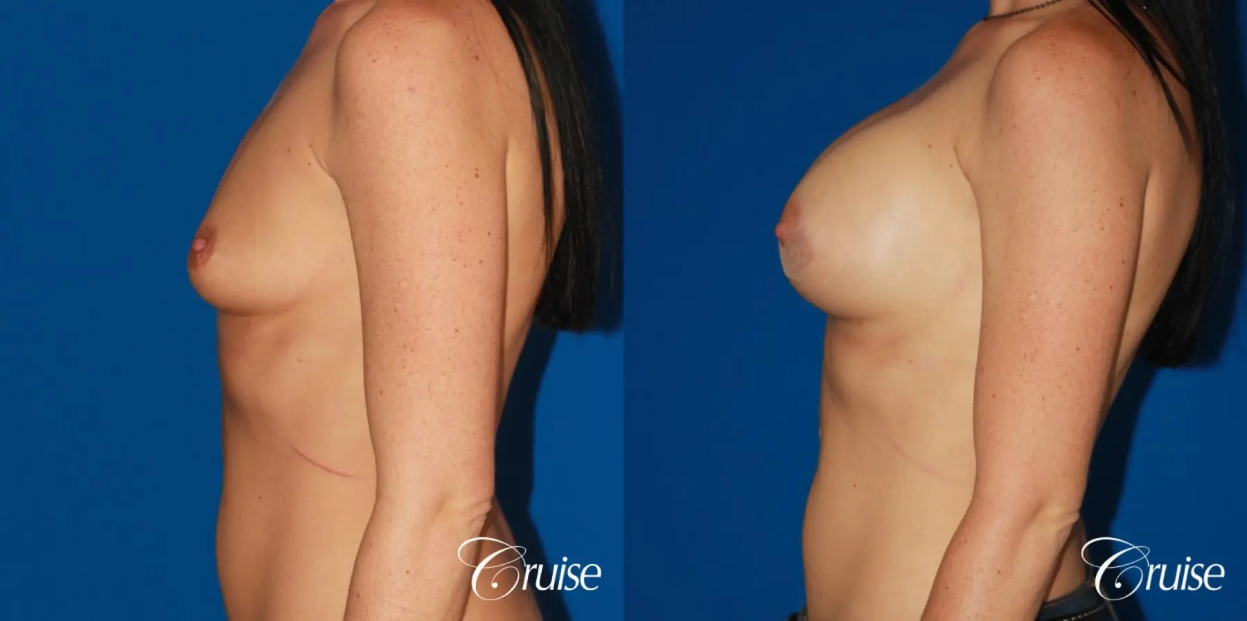 Breast Augmentation - Before and After 2