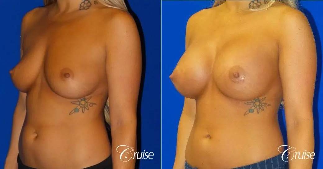 Breast Augmentation Irvine CA - Before and After 3