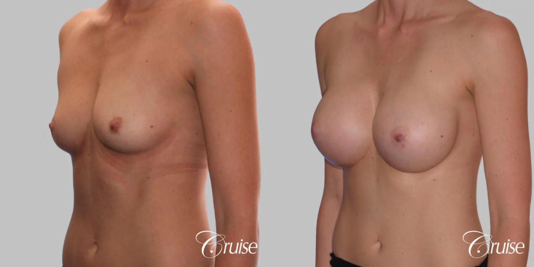 Breast Augmentation - Silicone HP 425cc - Before and After 2
