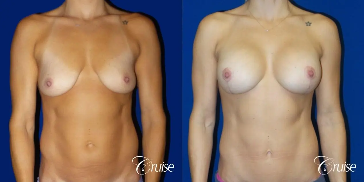 Breast Lift Anchor W/ Silicone Implants On Young Woman - Before and After 1