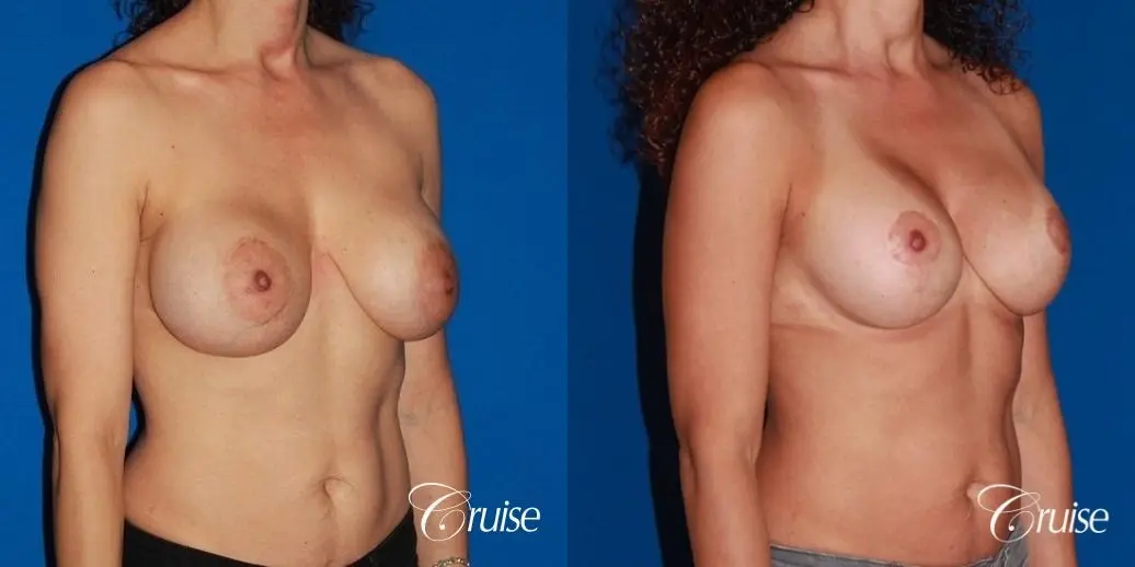 best breast lift revision with high profile silicone 425cc - Before and After 4