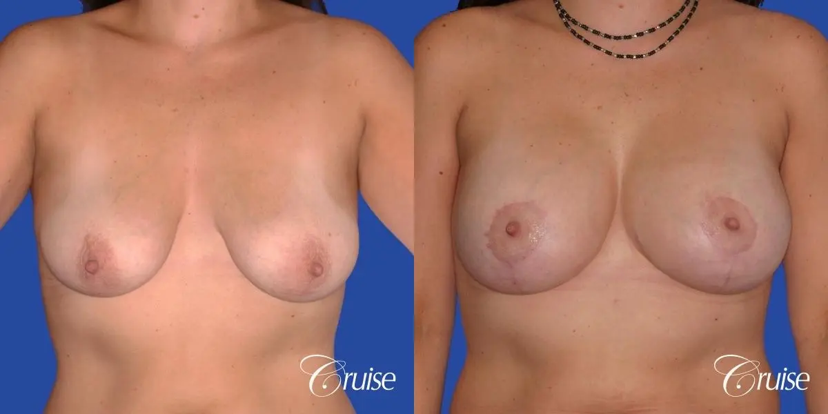 best results for breast lift surgeon in Newport Beach - Before and After 1