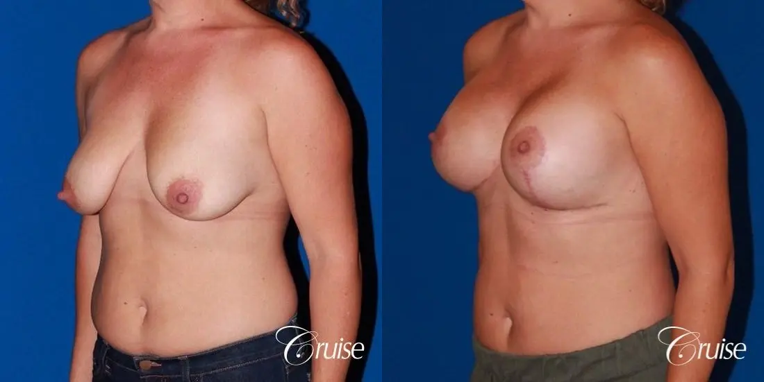 best results for breast lift anchor with saline implants - Before and After 3