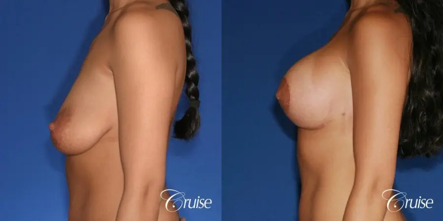 best breast lift anchor with silicone augmentation in Orange County - Before and After 2