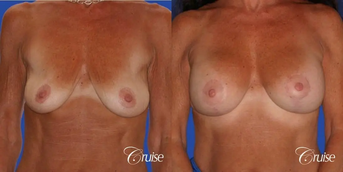 best results for breast lift in Orange County - Before and After 1