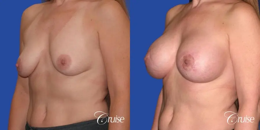 best breast lift donut scars in Newport Beach - Before and After 4