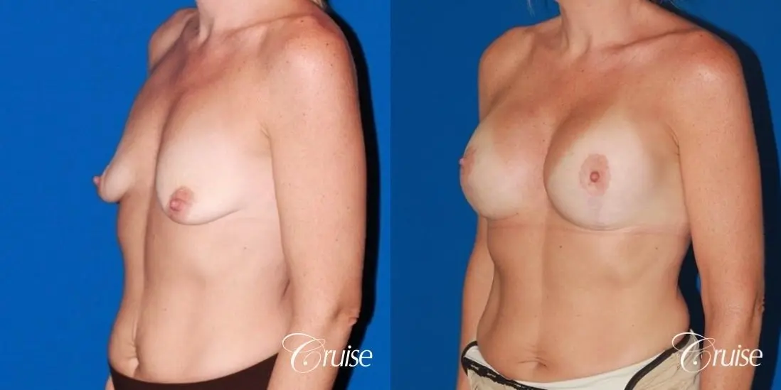 moderate profile saline breast lift anchor before and after pictures - Before and After 3