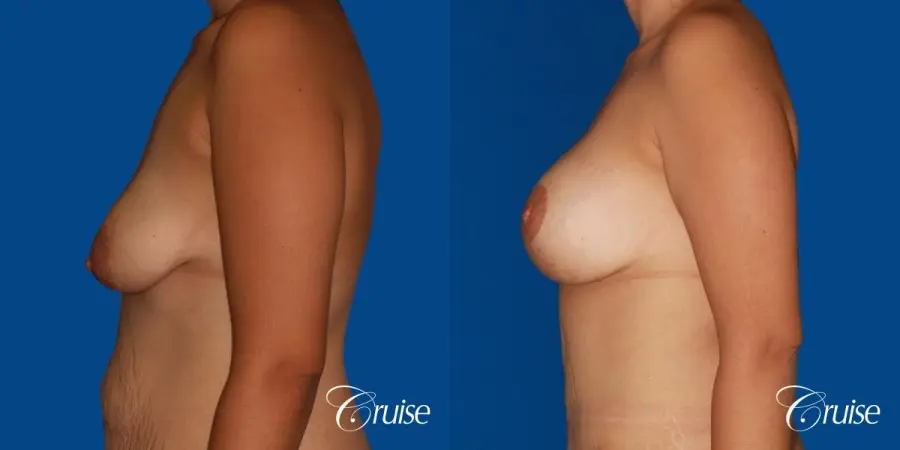 best breast lift anchor with saline augmentation - Before and After 2