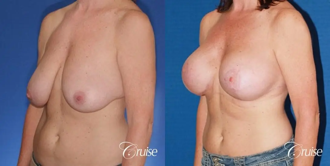 best breast lift anchor with high profile saline implants - Before and After 2