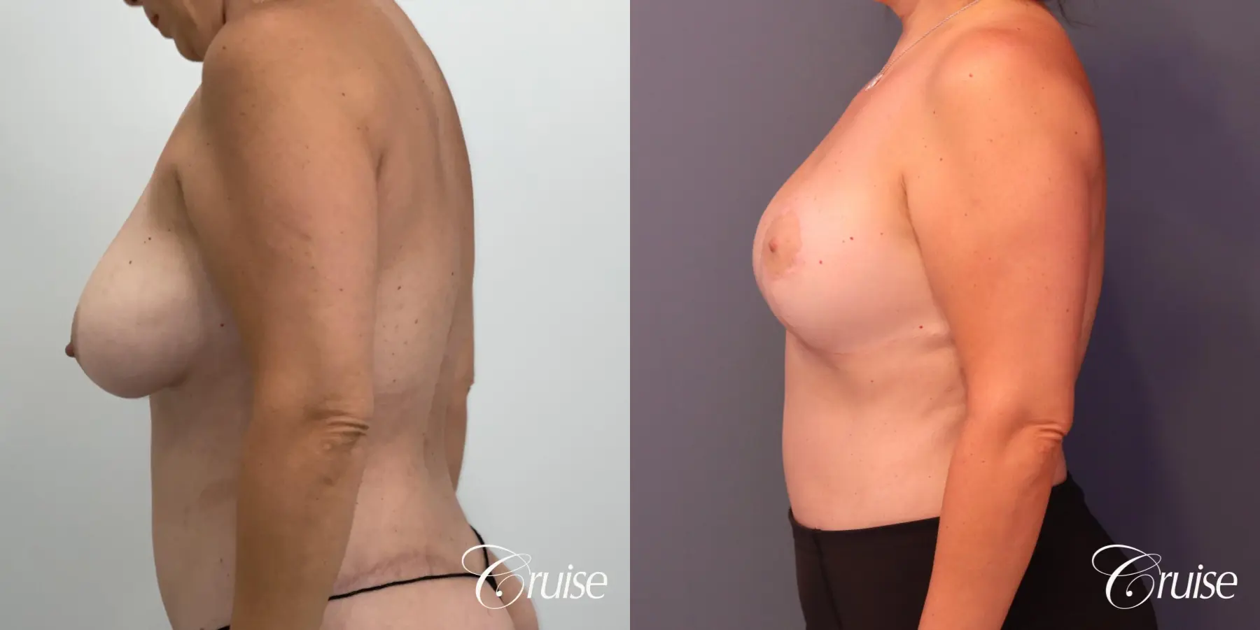 Breast Lift And Augmentation: Patient 74 - Before and After 3