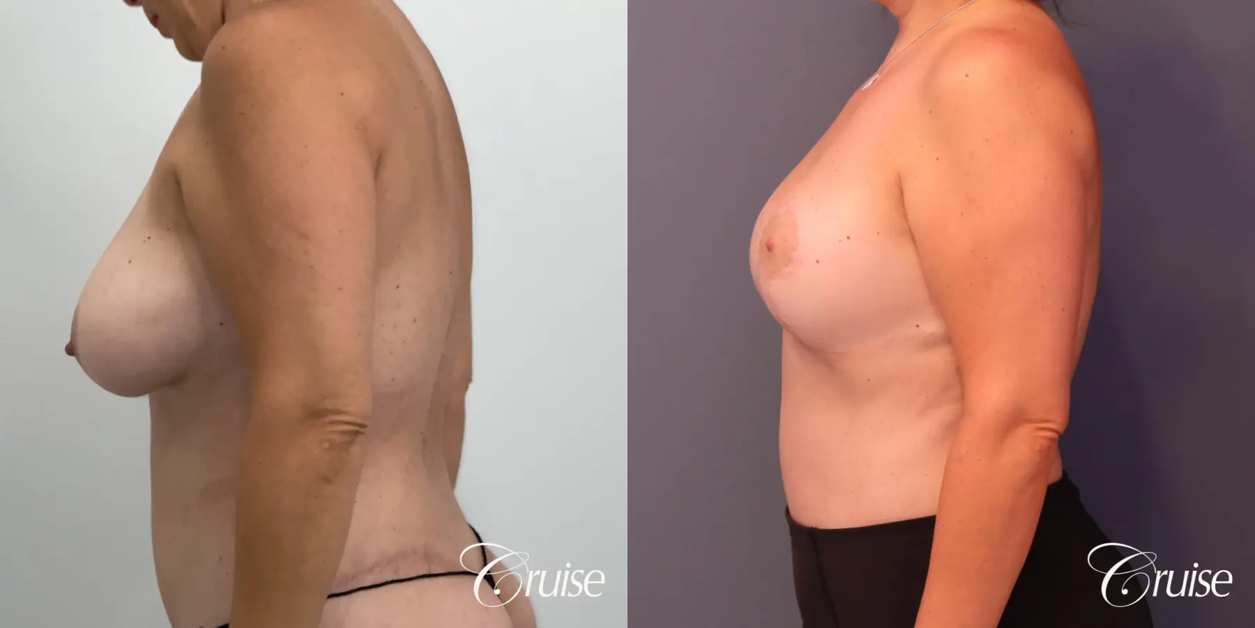 Breast Lift And Augmentation: Patient 76 - Before and After 3
