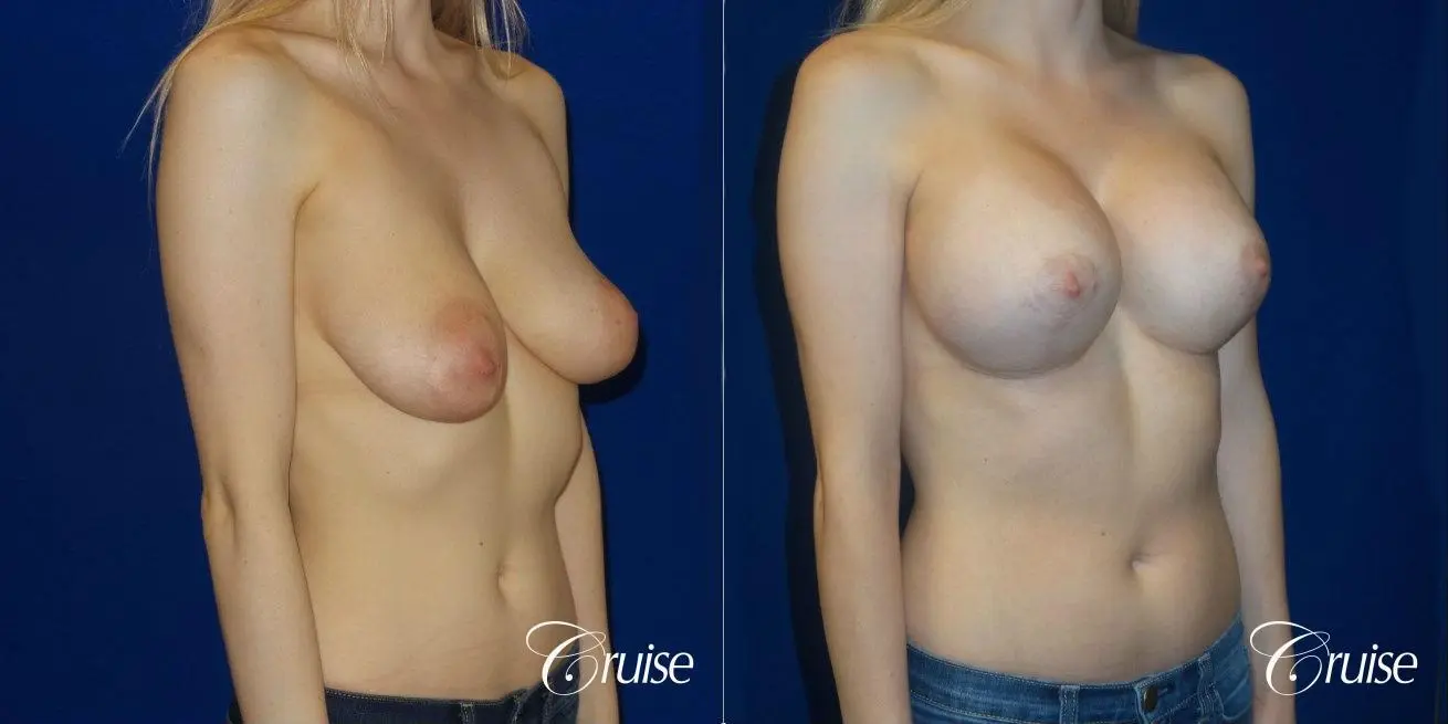 Breast Lift before and after Orange County - Before and After 2