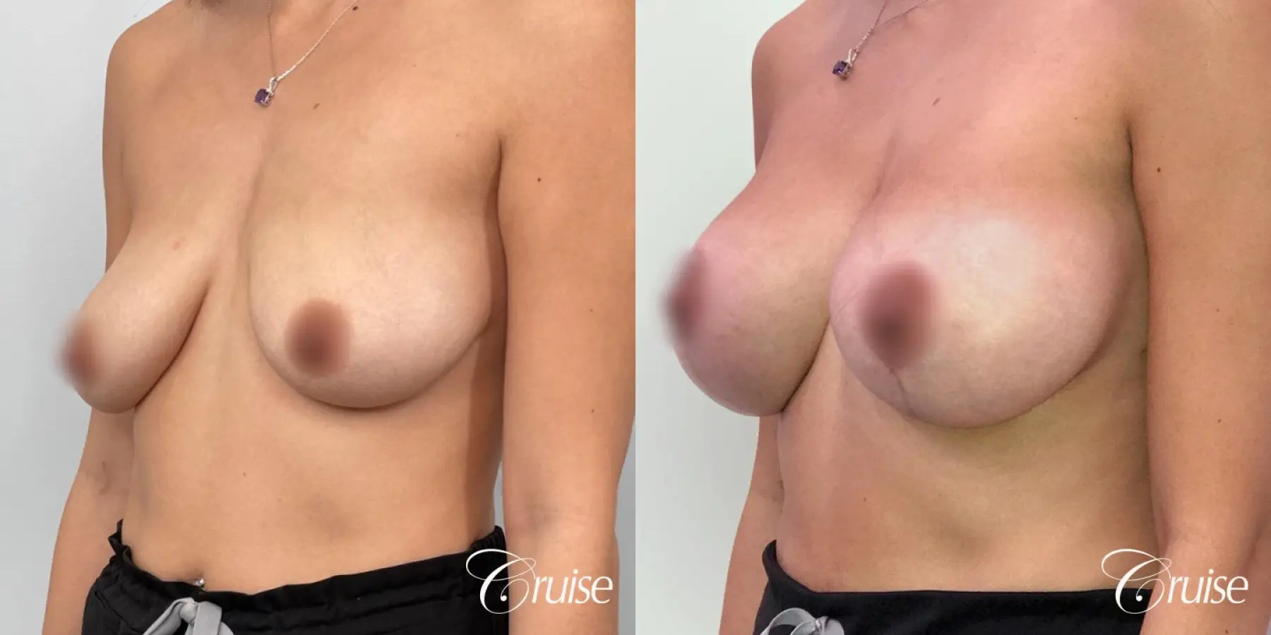 Mommy Breast Lift & Augmentation - Before and After 2