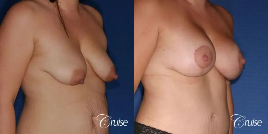 best results on young woman for breast lift anchor with saline augmentation - Before and After 4