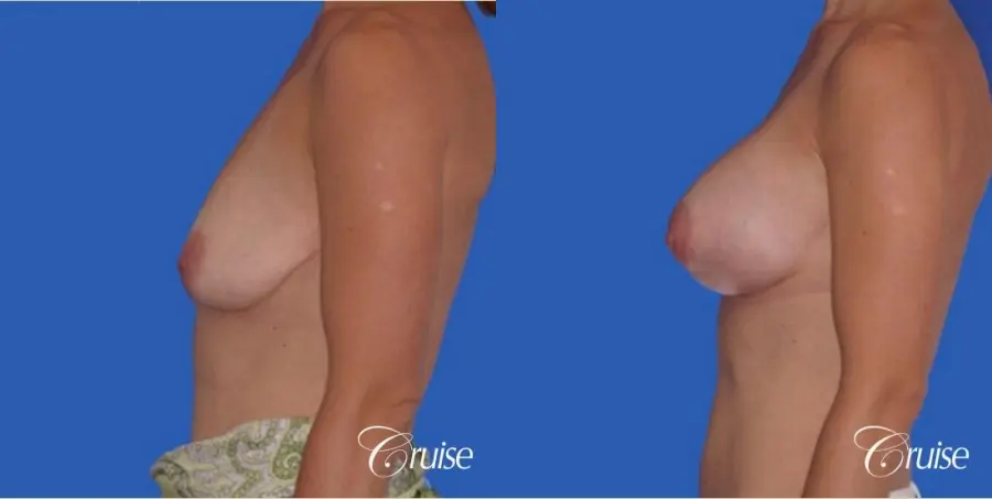 best breast lift anchor with silicone implants - Before and After 2