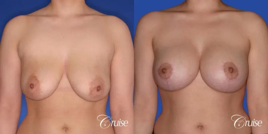 young woman who had best results for breast lift with saline implants - Before and After 1