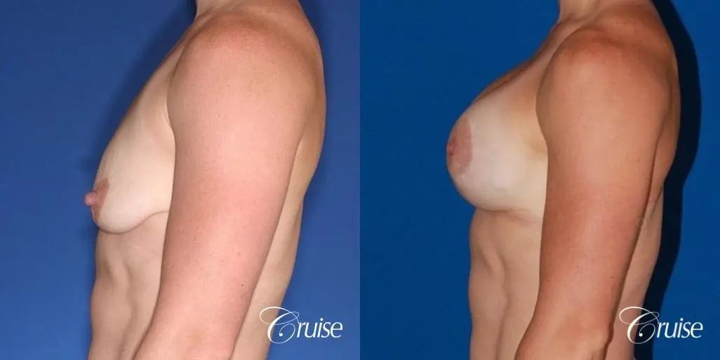 best breast lift anchor on athletic body type - Before and After 3