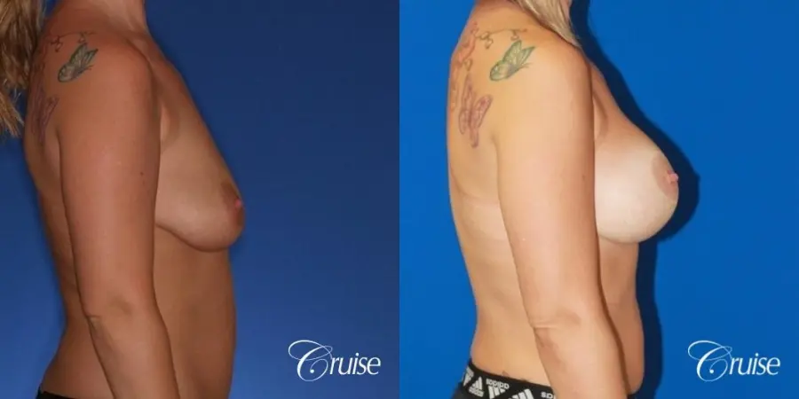 best before and after of breast lift anchor with high profile saline augmentation - Before and After 5