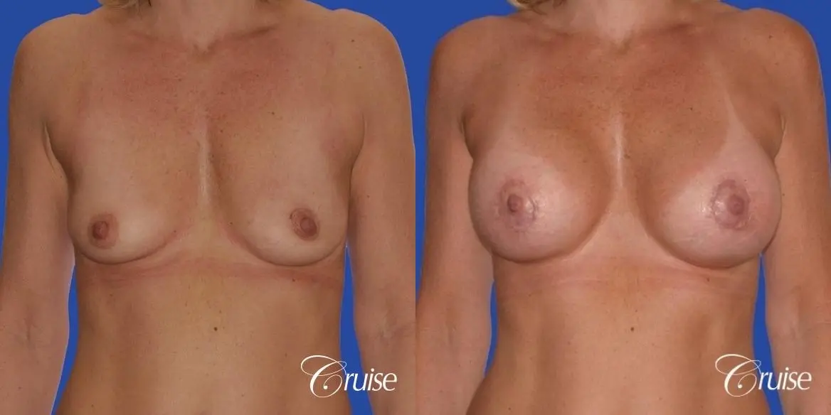 breast lift anchor with silicone implants on adult - Before and After 1