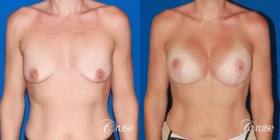 moderate profile saline breast lift anchor before and after pictures - Before and After 1