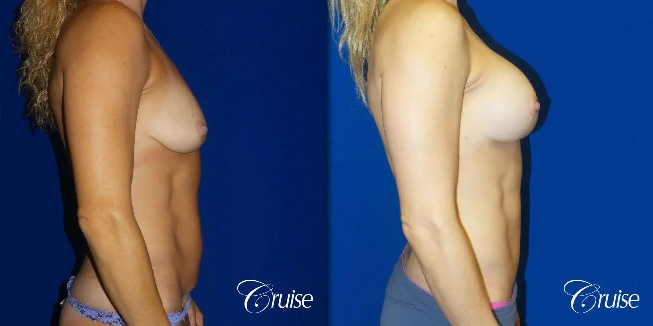 Breast Lift Anchor W/ Silicone Implants On Young Woman - Before and After 2