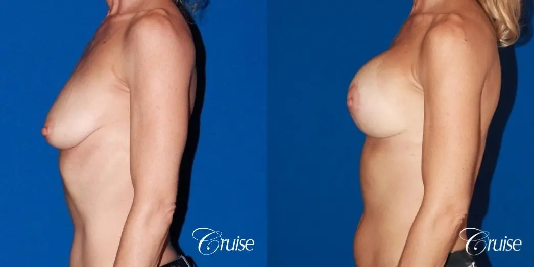 best breast lift results with high profile 375cc implants - Before and After 2