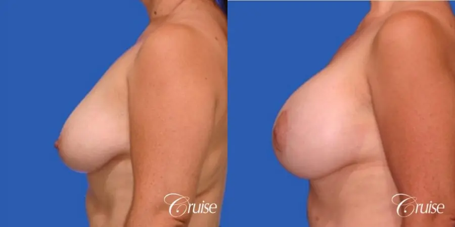best breast lift donut results with saline augmentation - Before and After 2