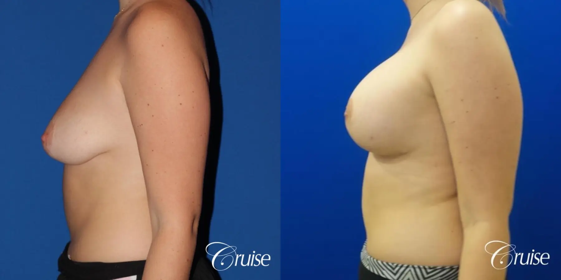 silicone implants with breast lift anchor newport beach - Before and After 2