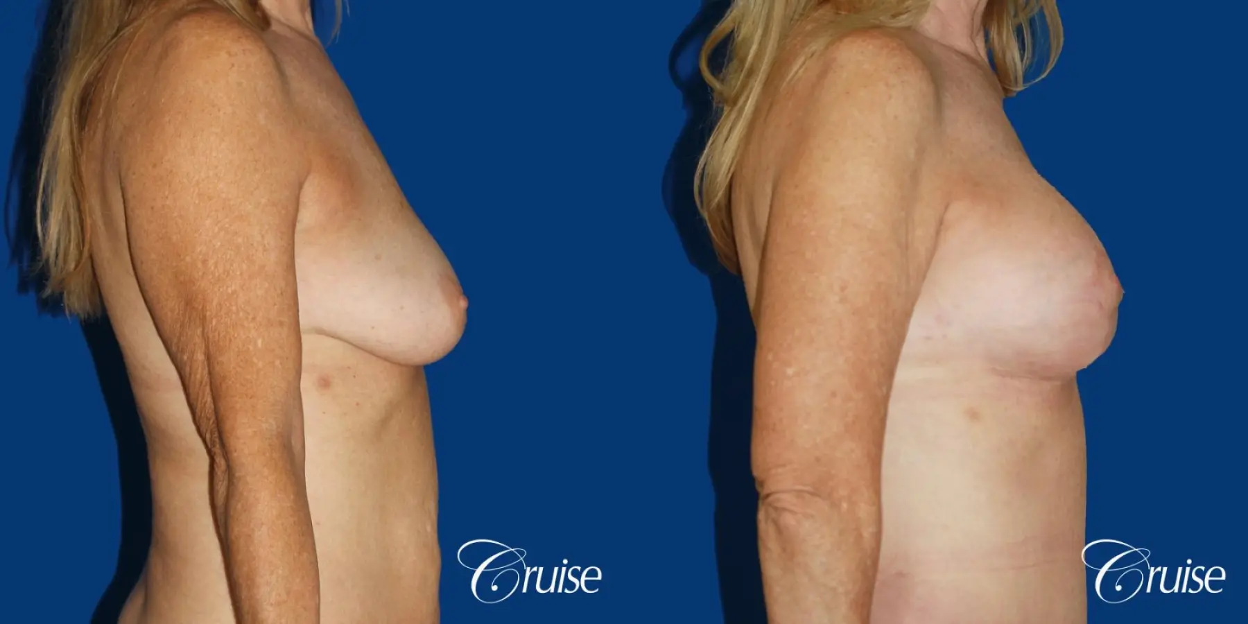 62 yr old woman with breast lift anchor and silicone implants - Before and After 2