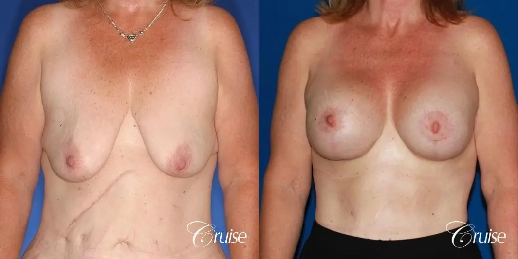 best anchor breast lift with specialist and plastic surgeon - Before and After 1