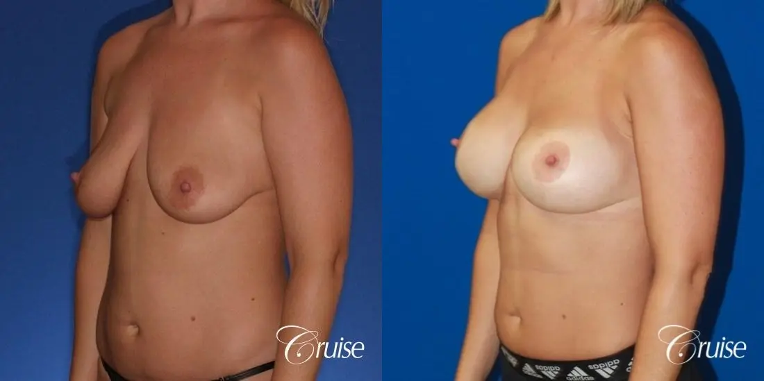 best before and after of breast lift anchor with high profile saline augmentation - Before and After 3