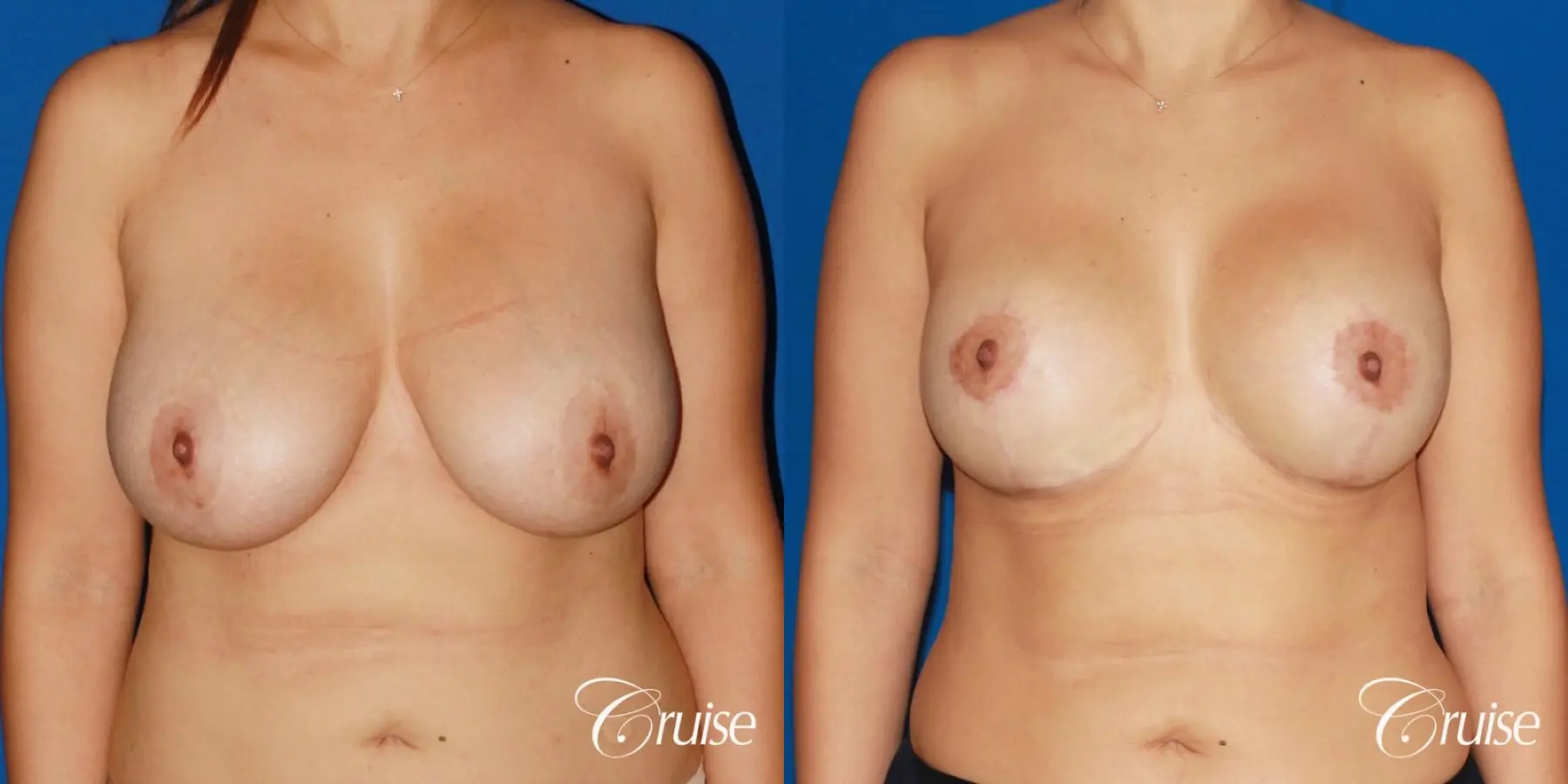 revision breast lift anchor with saline implants - Before and After 1