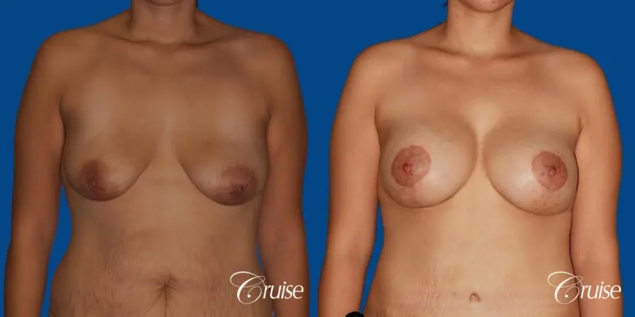 best breast lift anchor with saline augmentation - Before and After 1