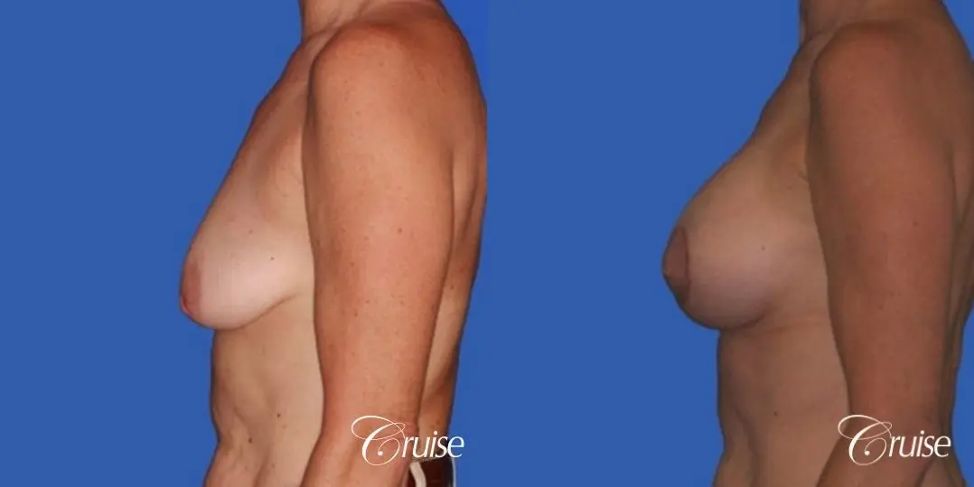 best breast lift donut pictures on mature woman - Before and After 2