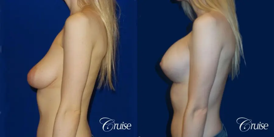 Breast Lift before and after Orange County - Before and After 4